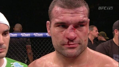 Photo: Shogun’s Mangled Nose After Henderson Right Hand